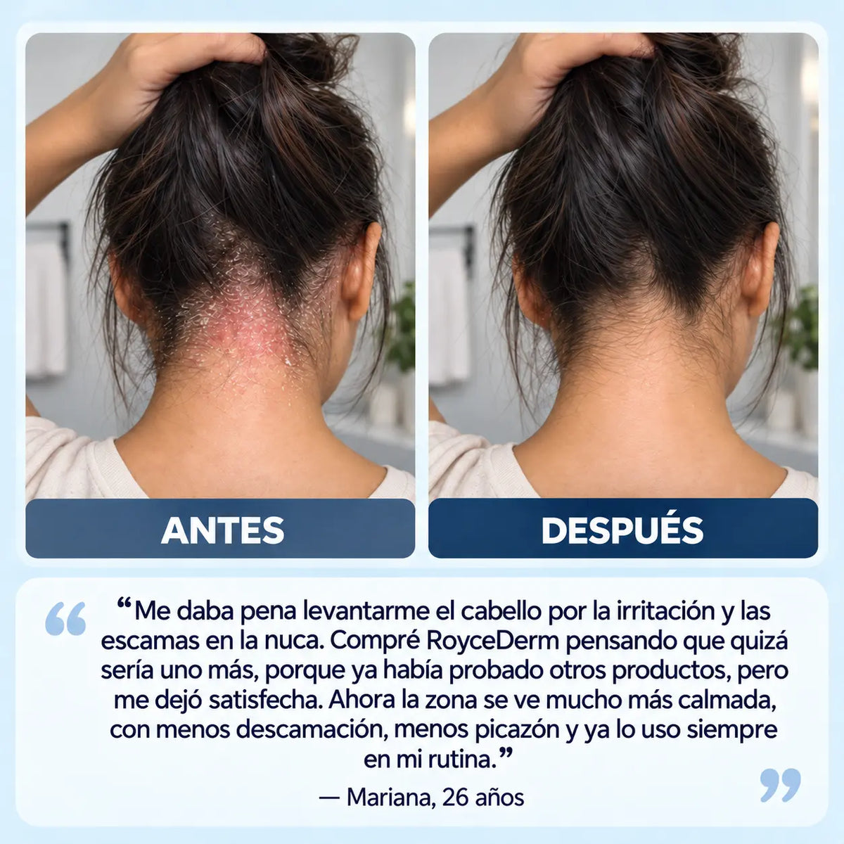 ROYCEDERM™ | DESCAMACION Y RESEQUEDAD